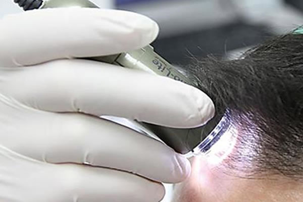 tricoscopia capilar digital no tratamento da calvicie masculina rj tijuca