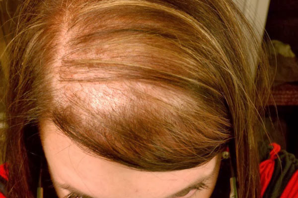 doencas capilares que causam queda de cabelo