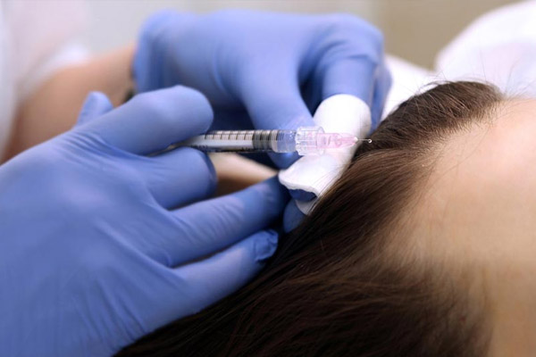 mesoterapia no tratamento da queda de cabelo no rio de janeiro, tijuca